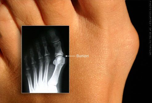 Bunion vulgus deformitet av stortån