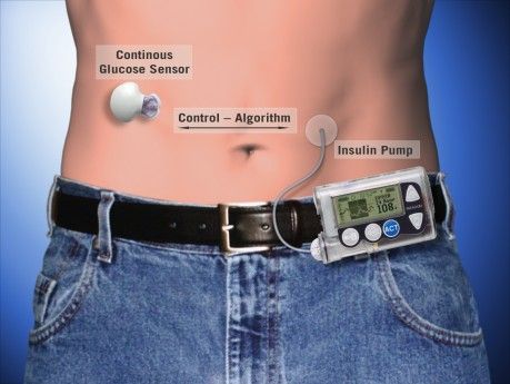 diabetes artificiell bukspottkörtel