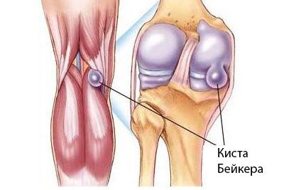 Baker cyst