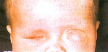 Mikroftalmos med tillhörande cystbildning (vänster öga). Anoftalmos (höger öga).