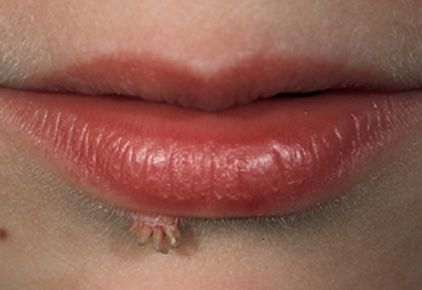 Threadlike warts