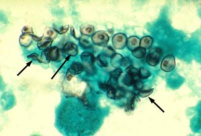 Det orsakande agenset av pneumocystis (Pneumocystis jiroveci)