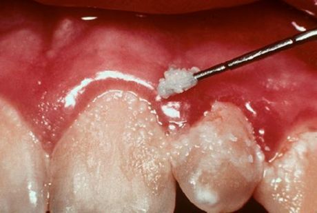 Tänder och gingivit