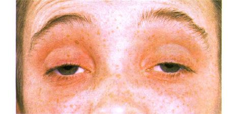 Extern oftalmoplegi.  Dubbelsidig ptos.  Patienten öppnar ögonen genom att lyfta ögonbrynen
