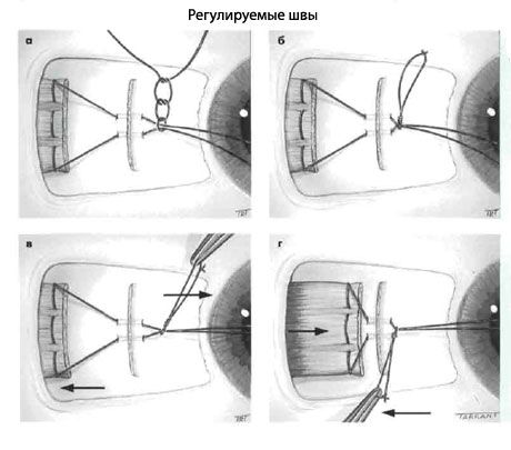 Strabismus - Operation
