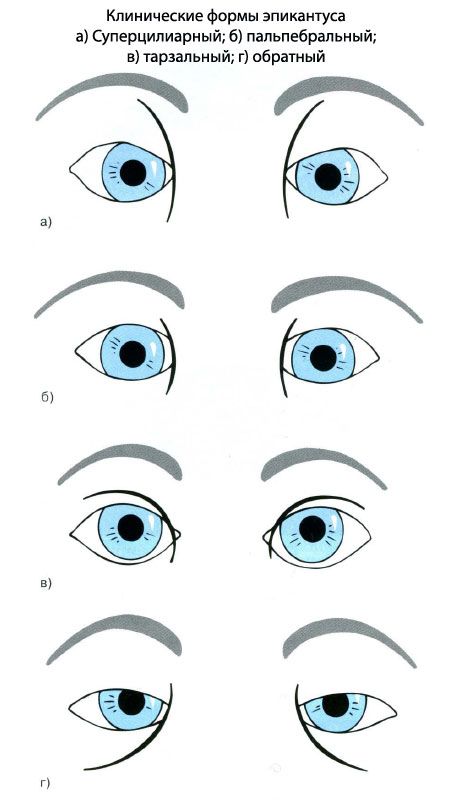 Kliniska former av epicanthus.  a) Superciliary, b) palpebral, c) tarsal, d) omvänd